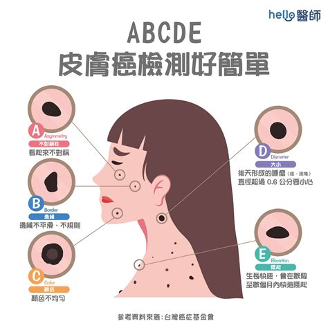 屁股長黑斑|皮膚長痣、長斑是皮膚癌前兆？皮膚癌初期4大症狀快。